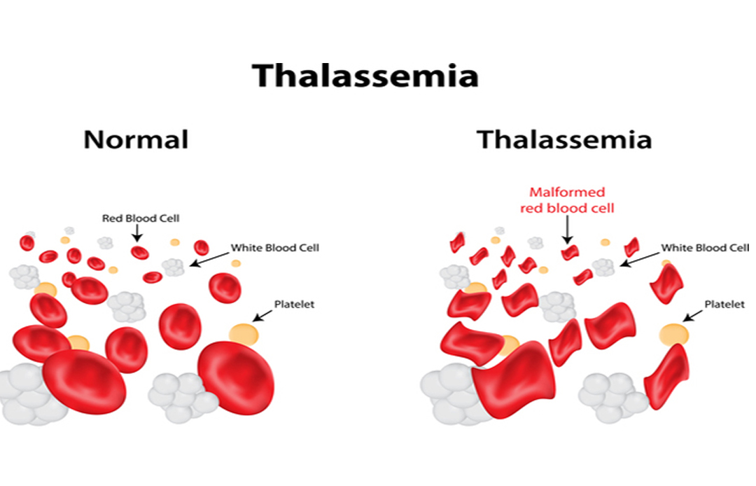 Combating Thalassemia in the UAE